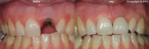 Dental Implants